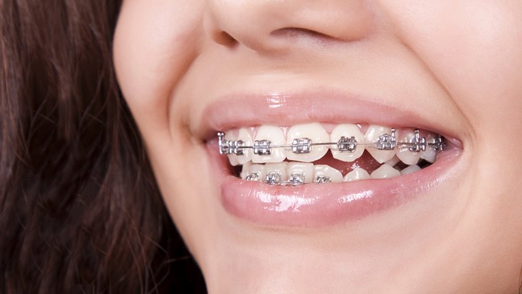 how to take off braces braces colors wheel